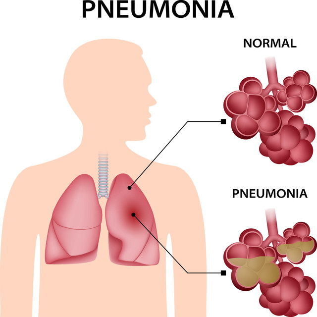 normal lungs