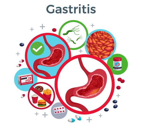 what can cause gastritis 