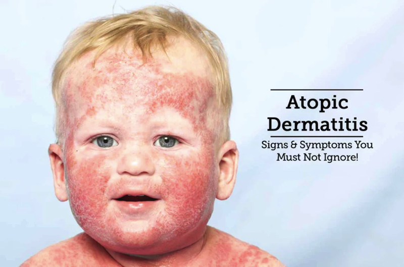 dermatitis in children